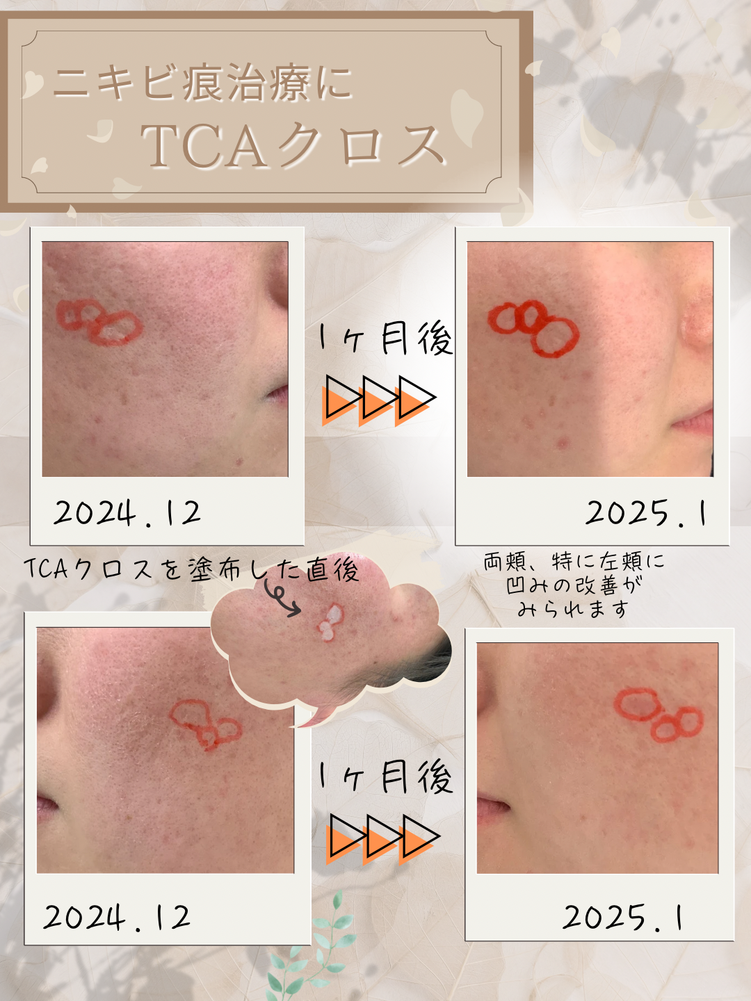 TCAクロスの記事もご参照下さい