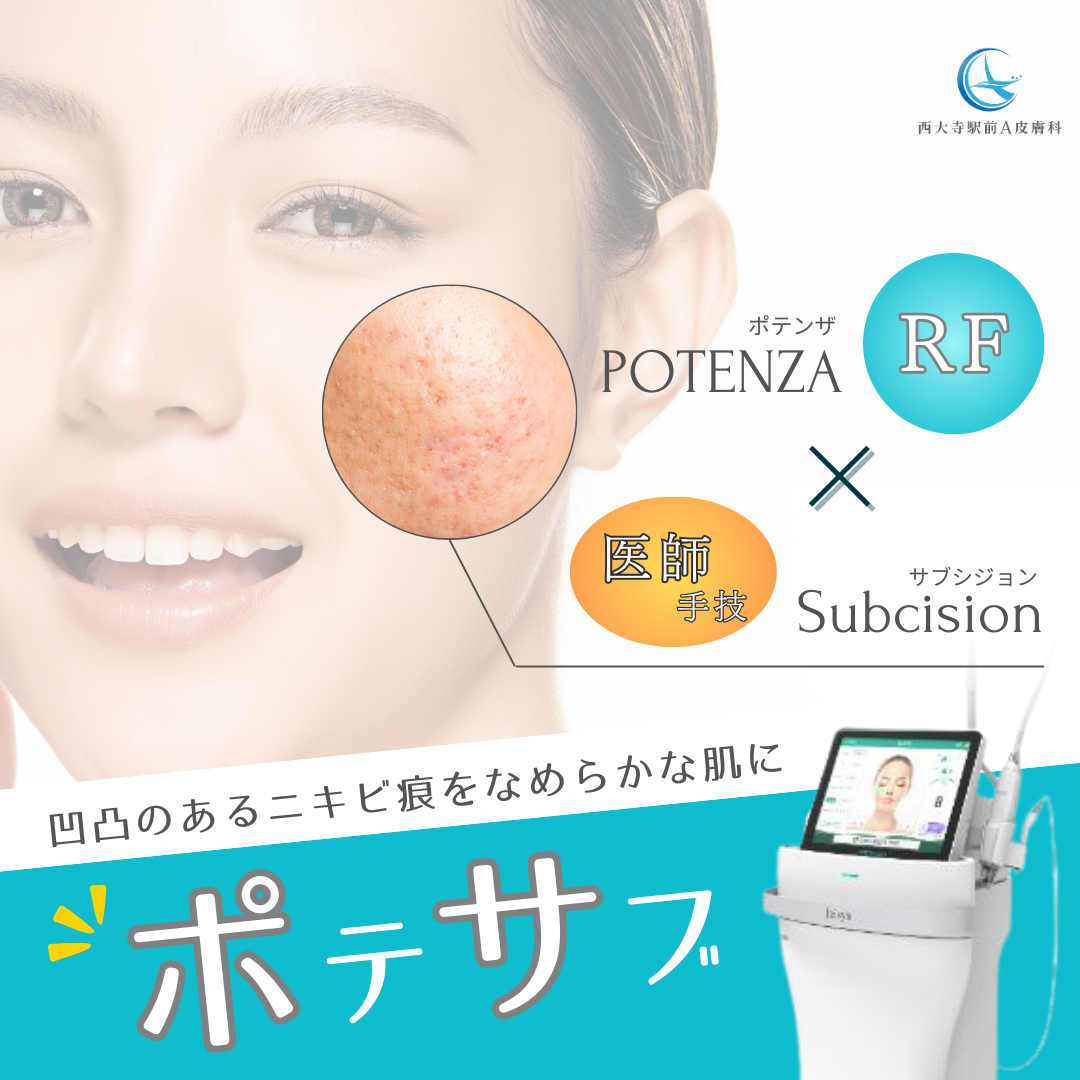 奈良市・西大寺駅前A皮膚科のポテサブ（ポテンザ×サブシジョン×ジュベルック）によるニキビ痕・クレーター肌治療の紹介画像。最新RF機器と医師の手技で滑らかな肌へ導くハイブリッド治療。