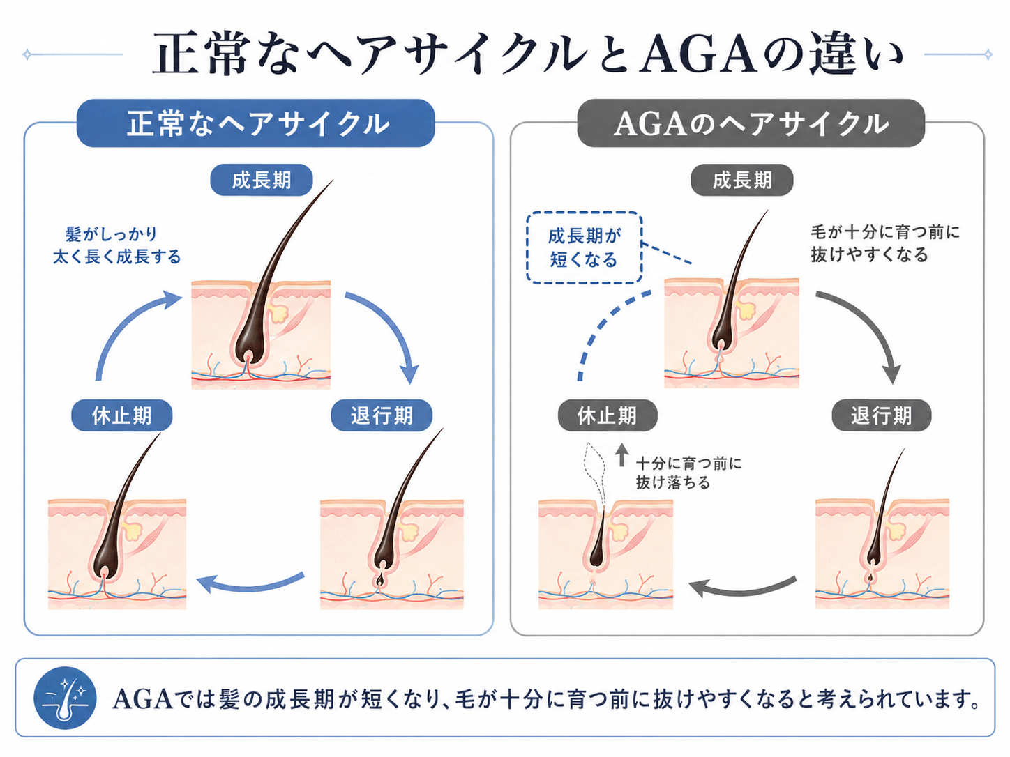 AGAの主な原因（テストステロン・DHT・毛根への影響）を示す図