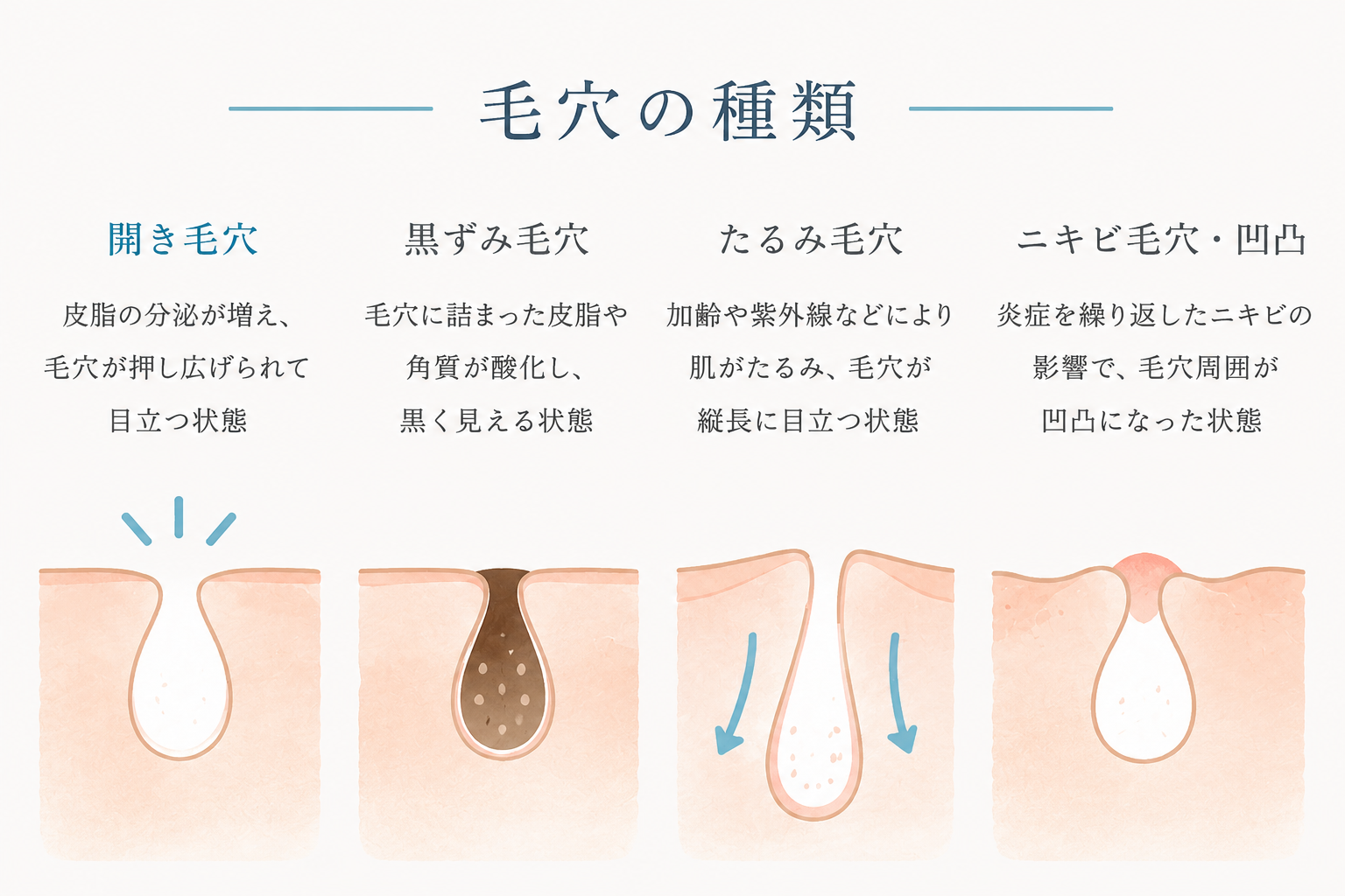 毛穴の種類の図解。開き毛穴は皮脂の分泌が増え毛穴が押し広げられて目立つ状態、黒ずみ毛穴は毛穴に詰まった皮脂や角質が酸化し黒く見える状態、たるみ毛穴は加齢や紫外線により肌がたるみ毛穴が縦長に目立つ状態、ニキビ毛穴・凹凸は炎症を繰り返したニキビの影響で毛穴周囲が凹凸になった状態