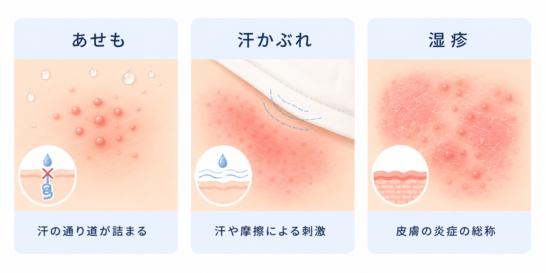 あせも・汗かぶれ・湿疹の違いのイラスト