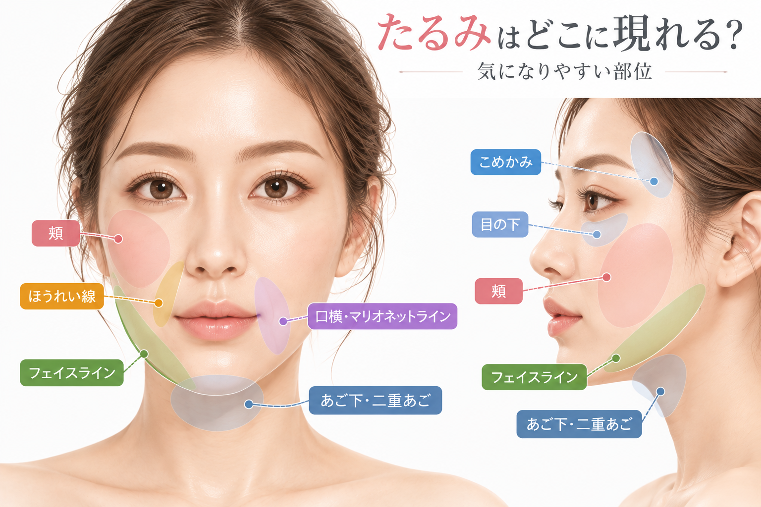 たるみが現れやすい部位：頬、ほうれい線、口横・マリオネットライン、フェイスライン、あご下