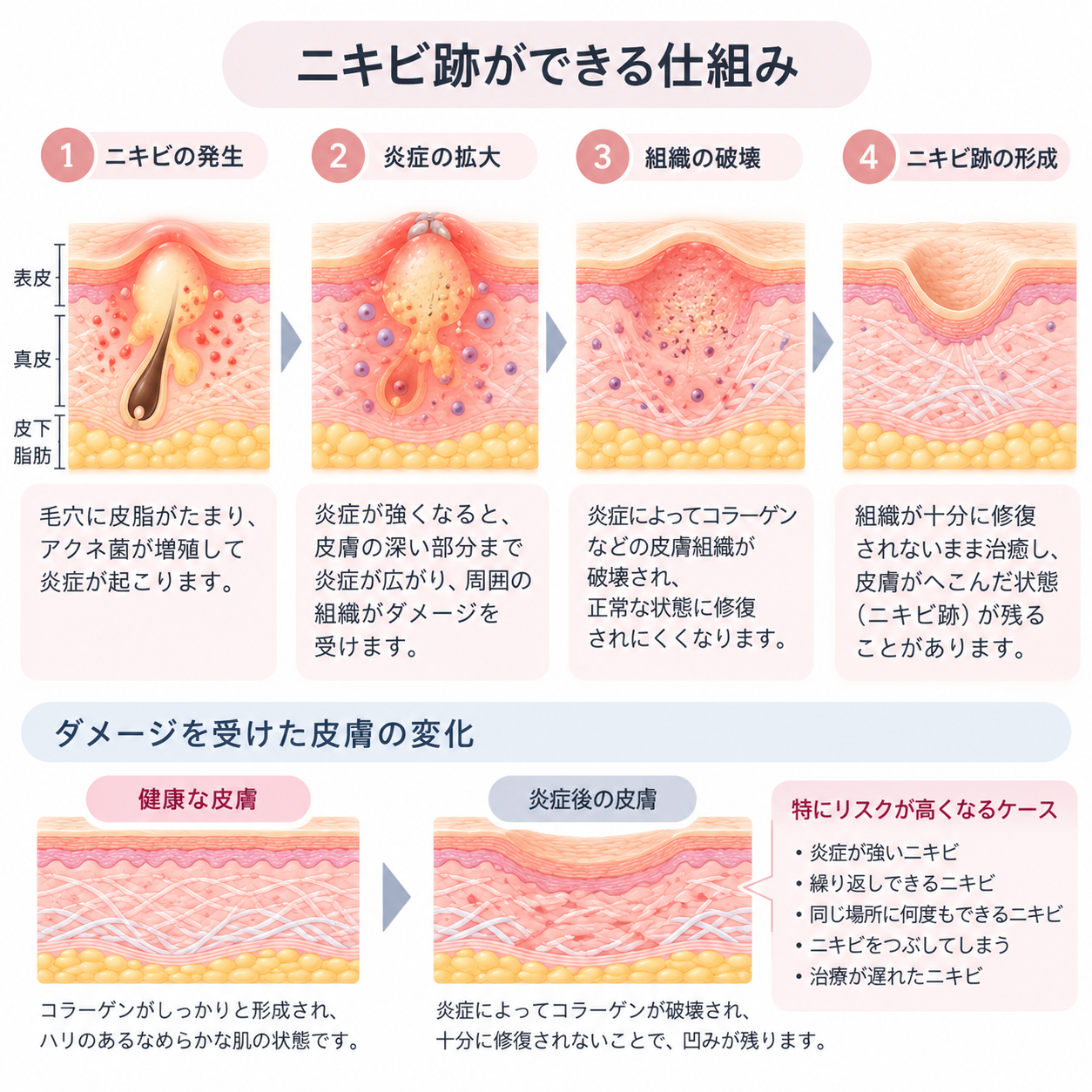 ニキビ跡ができる仕組み：ニキビの発生、炎症の拡大、組織の破壊、ニキビ跡の形成までの4段階と、健康な皮膚と炎症後の皮膚の違い